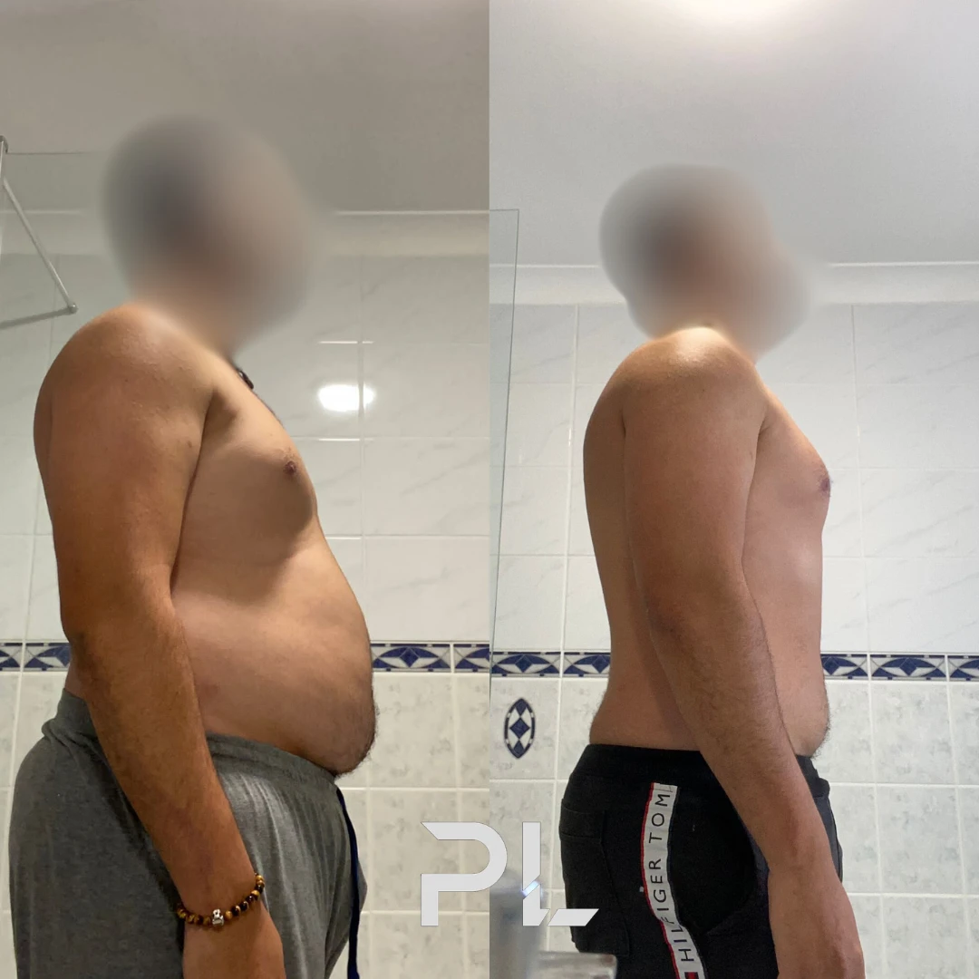 Client before and after: side view, belly gone